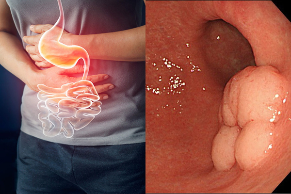 Ung thư dạ dày thường không gây ra các triệu chứng trong giai đoạn đầu. 