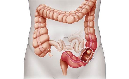 Các triệu chứng ung thư ruột kết dễ nhận thấy hơn ở giai đoạn 3 và 4.