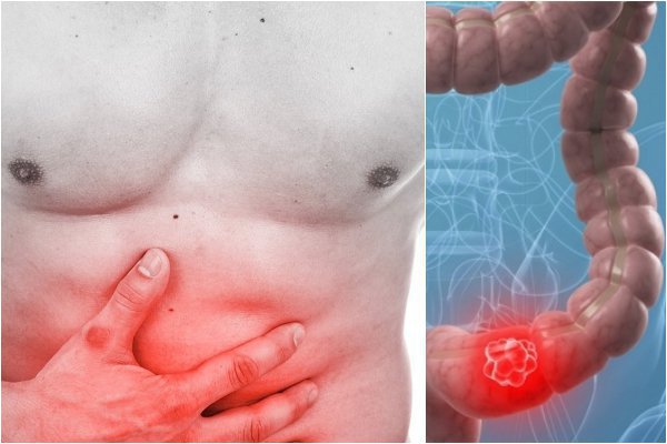 Bệnh ung thư ruột kết có thể được chữa khỏi không?
