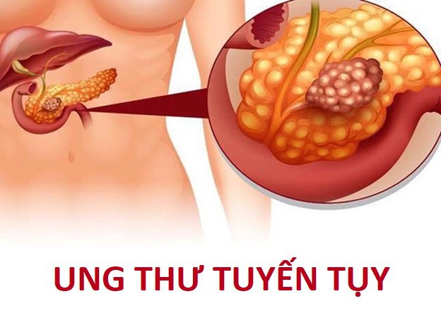 Bệnh ung thư tuyến tụy xảy ra trong các mô của tuyến tụy, là một cơ quan nội tiết quan trọng nằm phía sau dạ dày.