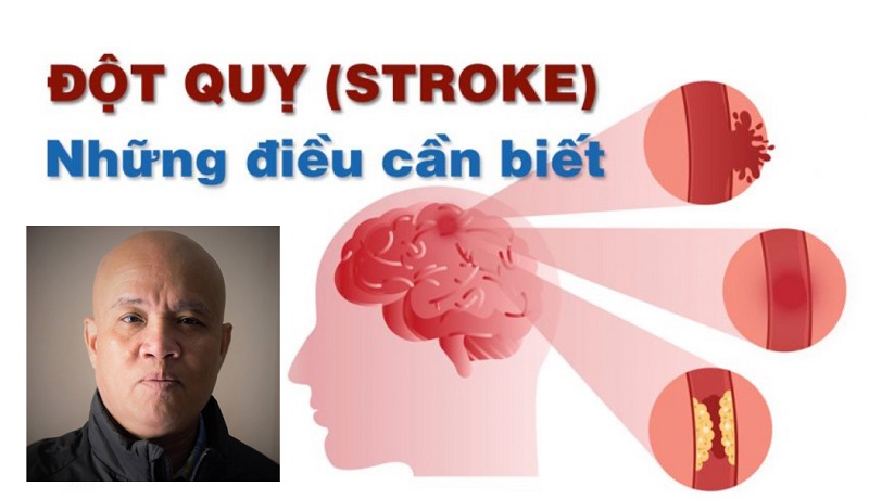 Những kiến thức đúng về nguyên nhân, điều trị và phòng ngừa đột quỵ
