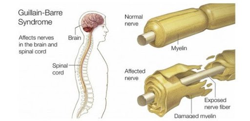 Giống như nhiều bệnh khác, chẩn đoán GBS chủ yếu dựa vào các triệu chứng của bệnh nhân cũng như khám thần kinh.