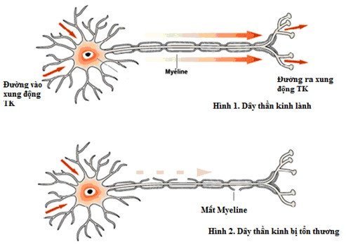 GBS thường được kích hoạt bởi nhiễm vi rút hoặc vi khuẩn.