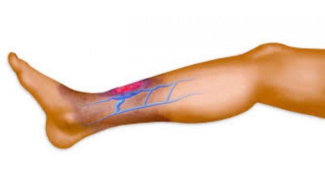 Biến chứng của suy giãn tĩnh mạch?