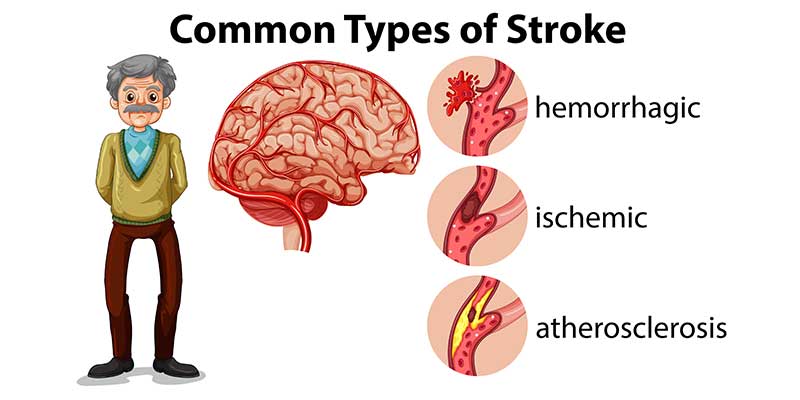 Đột quỵ có thể xảy ra do vỡ mạch hoặc tắc mạch máu