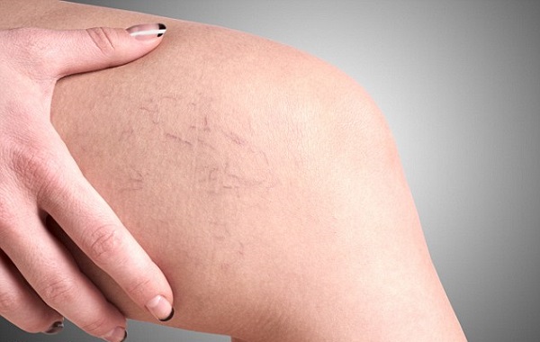 Suy giãn tĩnh mạch và dấu hiệu để nhận biết?