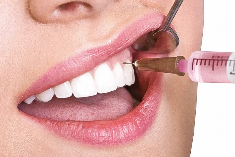 Thuốc tê trong nha khoa sẽ gây đến tê môi, lưỡi