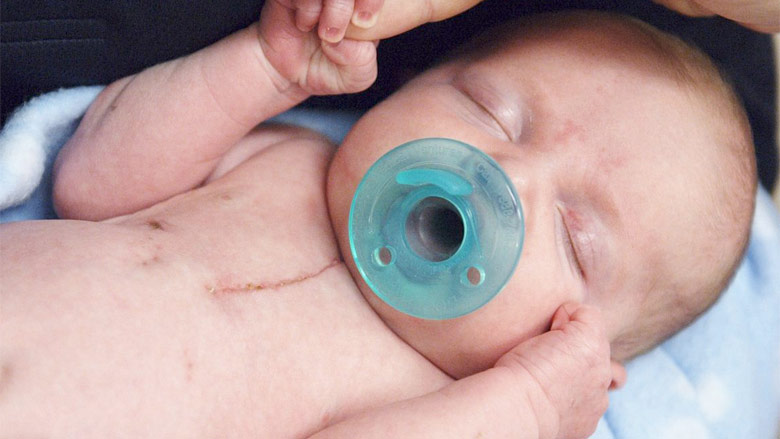 Bệnh nhân bị chuyển vị của các động mạch lớn cần phải phẫu thuật sớm để sống sót. 