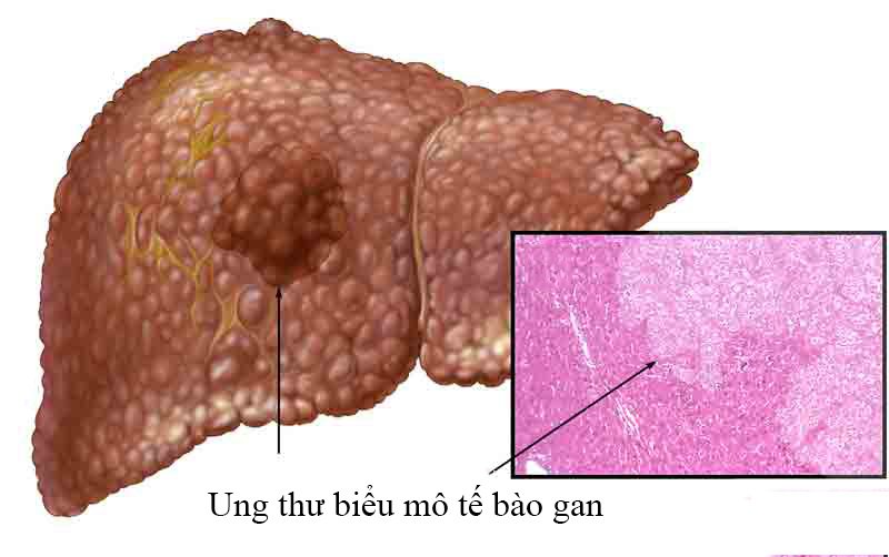 Ung thư biểu mô tế bào gan (HCC) là dạng ung thư gan phổ biến nhất.