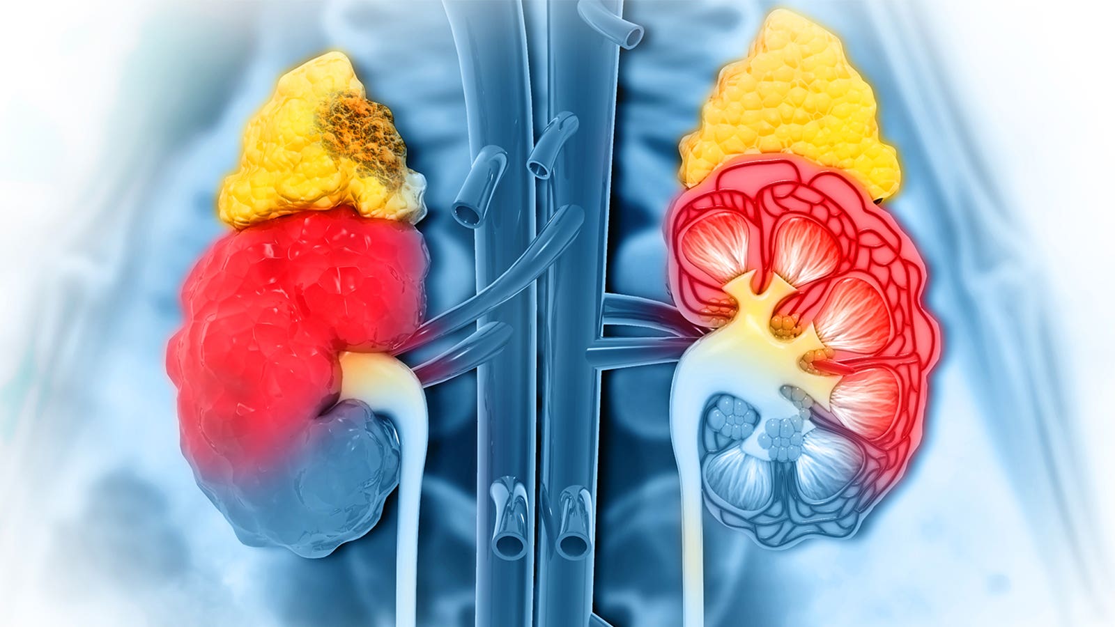 Ung thư thượng thận thường xảy ra ở lớp ngoài cùng của các tuyến, hoặc vỏ thượng thận.