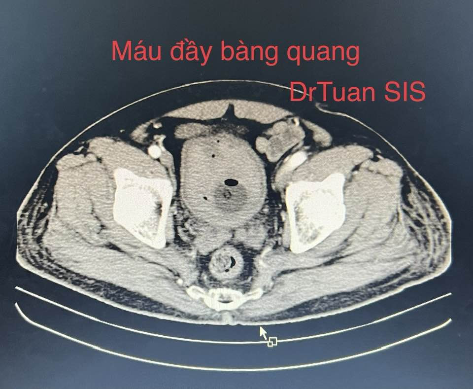 Hình ảnh chụp phim của bệnh nhân N.