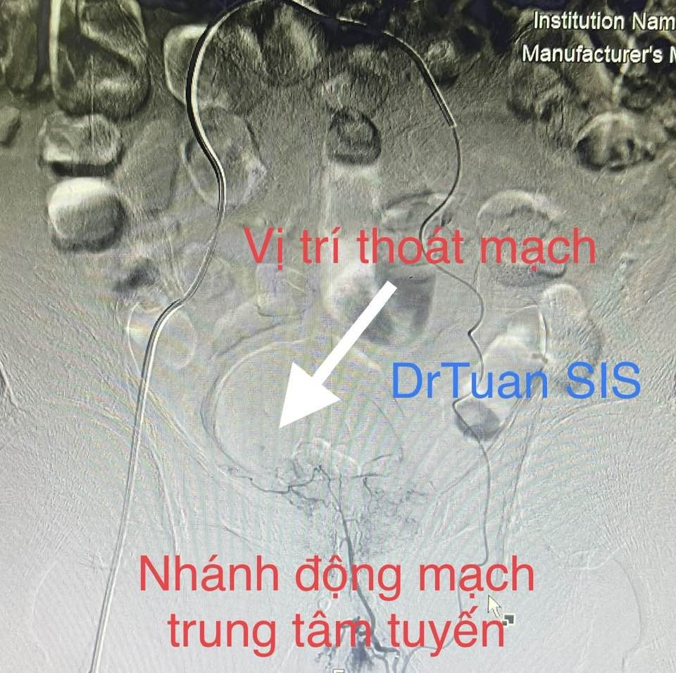 Hình ảnh chụp phim của bệnh nhân N.