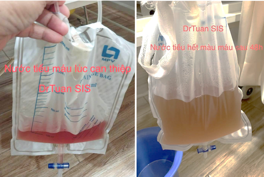 Màu nước tiểu trước và sau khi bệnh nhân N. can thiệp nội mạch DSA