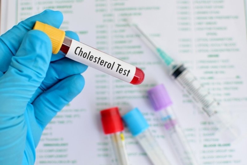 Xét nghiệm nhằm kiểm tra chính xác các nồng độ cholesterol và triflyceride HDL - Cholesterol, LDL - cholesterol trong máu.