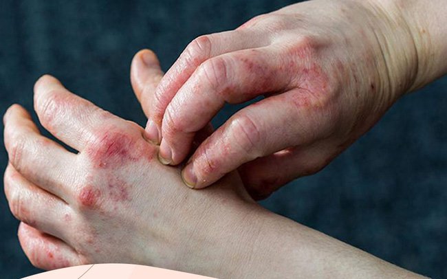 Bệnh tiểu đường cũng là nguyên nhân gây ra tình trạng ngứa bàn tay và bàn chân