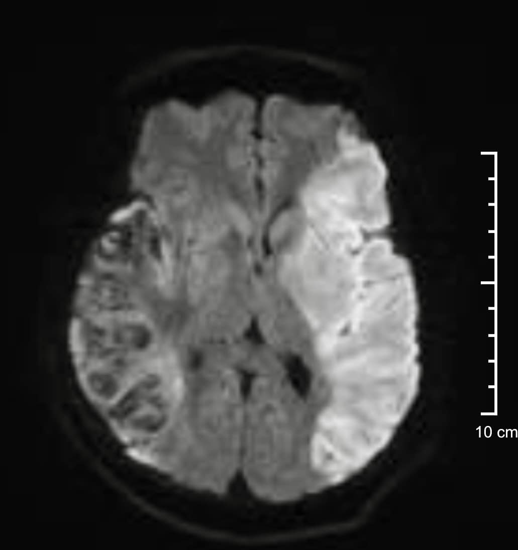 TTƯT.PGS.TS.BS Nguyễn Huy Thắng: Cần phòng ngừa biến cố thuyên tắc ở bệnh nhân đột quỵ nhẹ