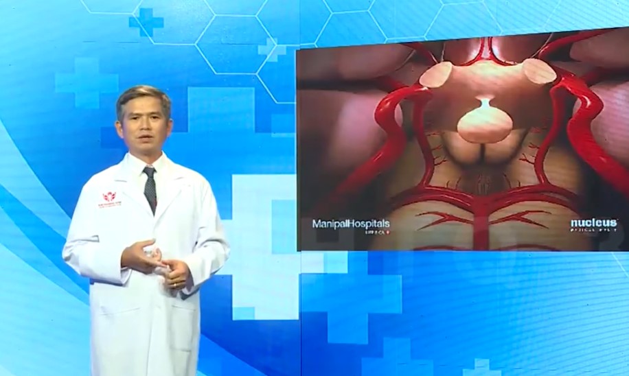 Tìm hiểu về đột quỵ xuất huyết não do tăng huyết áp và dị dạng mạch máu não