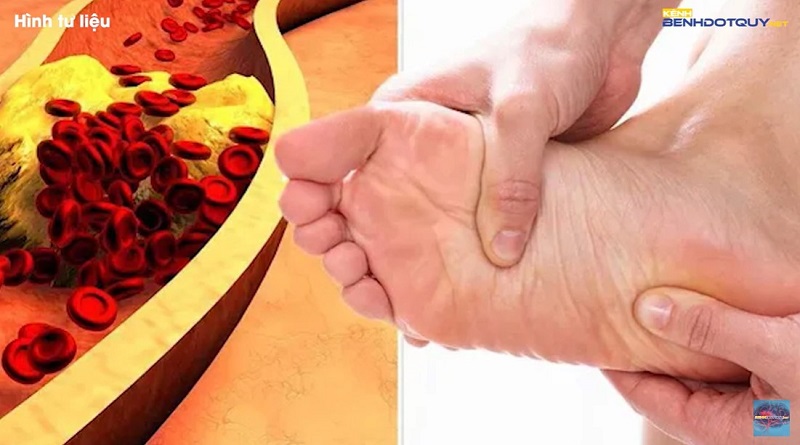 Đừng bỏ qua những dấu hiệu ban đầu của bệnh mỡ máu cao