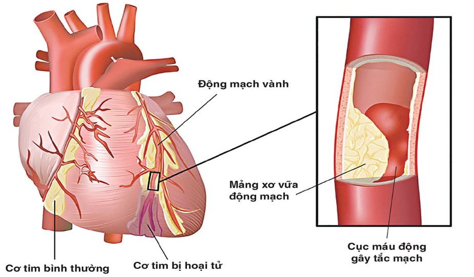 Quét canxi mạch vành là một phương pháp dự báo các biến cố mạch vành tốt hơn so với sàng lọc cholesterol hoặc các đánh giá yếu tố nguy cơ khác.