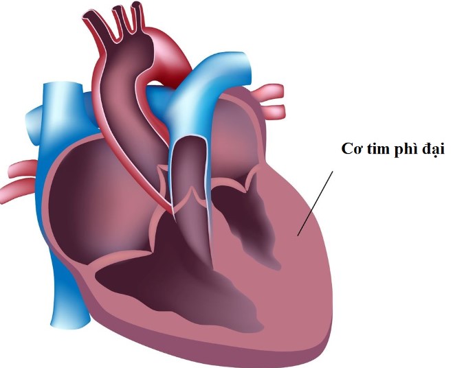 Bệnh cơ tim phì đại (Hypertrophic Cardiomyopathy) là bệnh lý di truyền do đột biến gen mã hóa protein của cấu trúc sarcomere cơ tim.
