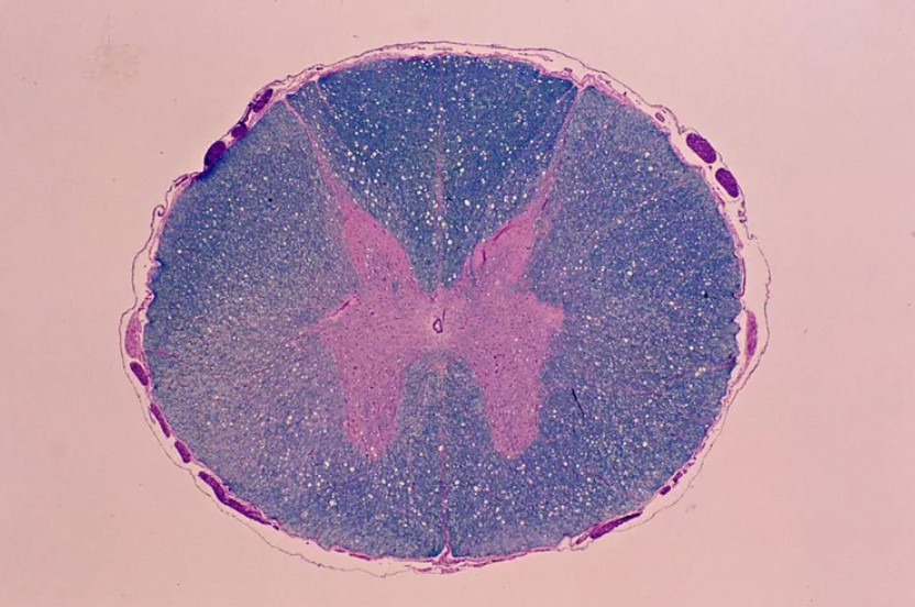 Viêm màng não carcinomatous có thể xảy ra như một biến chứng của nhiều loại ung thư.