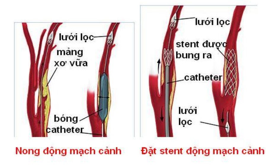 Stent có thể tồn tại lâu trong cơ thể