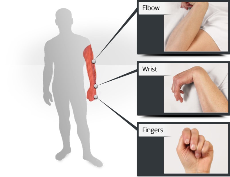 Co rút cơ tay chân thường gặp ở bệnh nhân sau đột quỵ