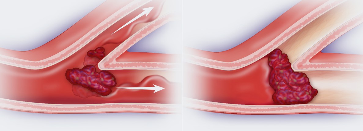 So với đột quỵ nhồi máu não thì TIA chỉ bị tắc nghẽn tạm thời chứ không tắc nghẽn hoàn toàn