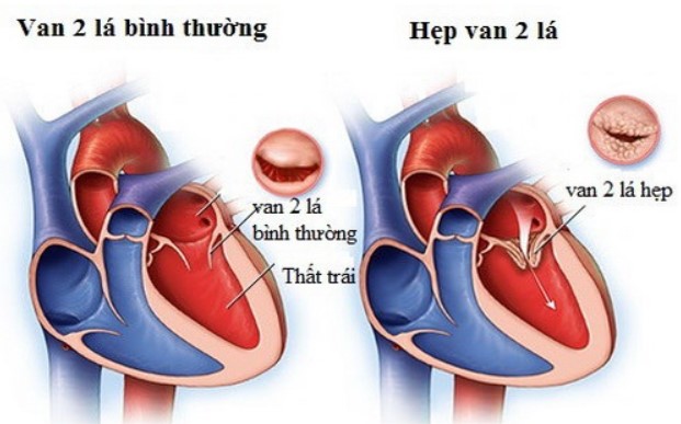 Loại hẹp van tim nào nguy hiểm nhất?
