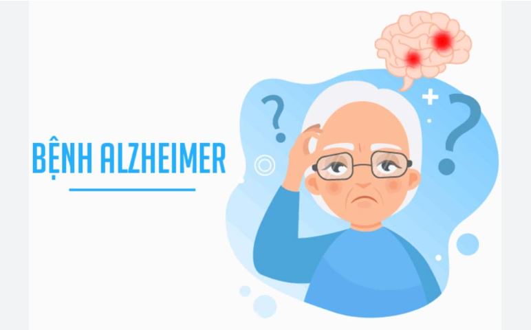 Loại thuốc mới hứa hẹn làm chậm tiến triển bệnh Alzheimer