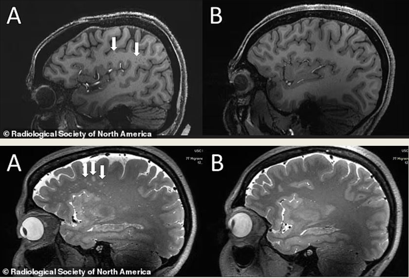 Hình ảnh khác biệt khi người bệnh đau nửa đầu chụp MRI, liệu đây có phải nguyên nhân cơn đau?