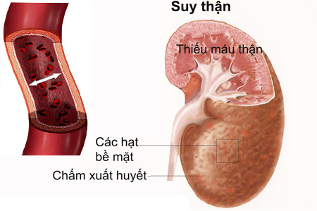 Bệnh thận đái tháo đường là tình trạng xơ cứng và xơ hóa cầu thận