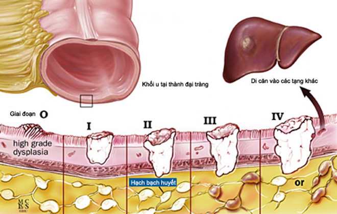 Ung thư giai đoạn 3 còn được gọi là ung thư tiến triển tại chỗ