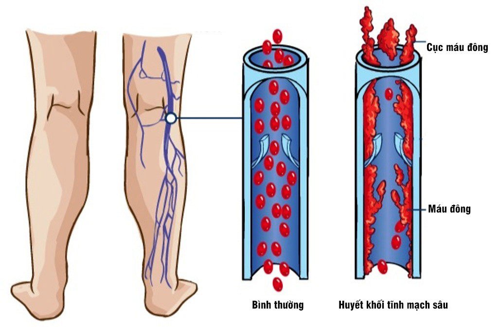 Huyết khối tĩnh mạch sâu (DVT) nguy hiểm thế nào?