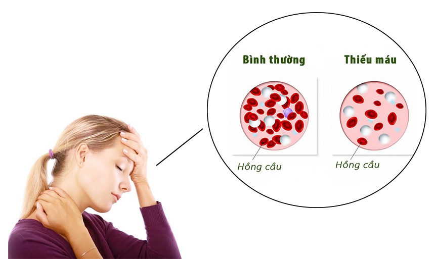 Thiếu máu có nhiều nguyên nhân có thể xảy ra.