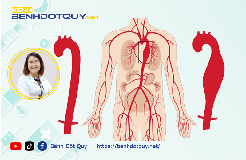 Phình động mạch chủ ngực có thể gây đột quỵ, phát hiện sớm được không?