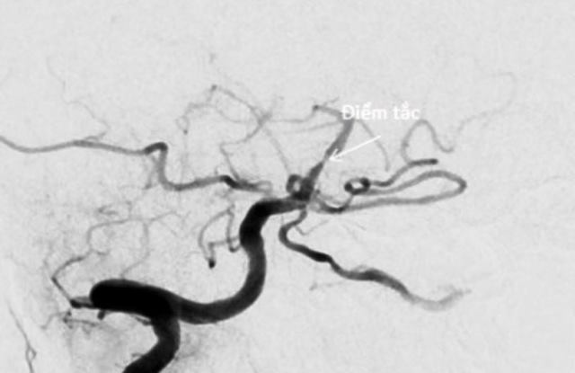 70 tuổi từng đột quỵ do hẹp động mạch nội sọ, có cách nào phòng ngừa tái phát?