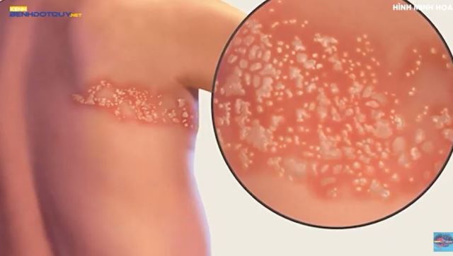 Bệnh zona khiến nguy cơ đột quỵ tăng hơn 30%