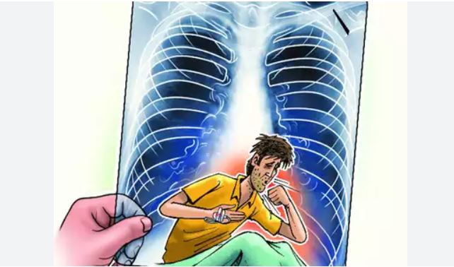Sụt cân nhanh, tràn dịch và lao, có phải bị thuyên tắc động mạch phổi?