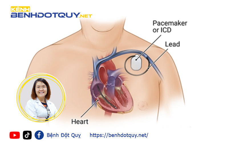 BS.CK1 Cao Thị Lan Hương giải đáp thắc mắc về máy tạo nhịp tim