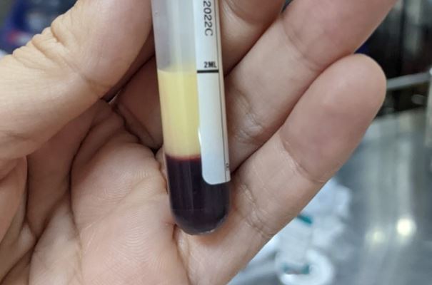 Máu trong mỡ là tình trạng gì, nguy hiểm ra sao?