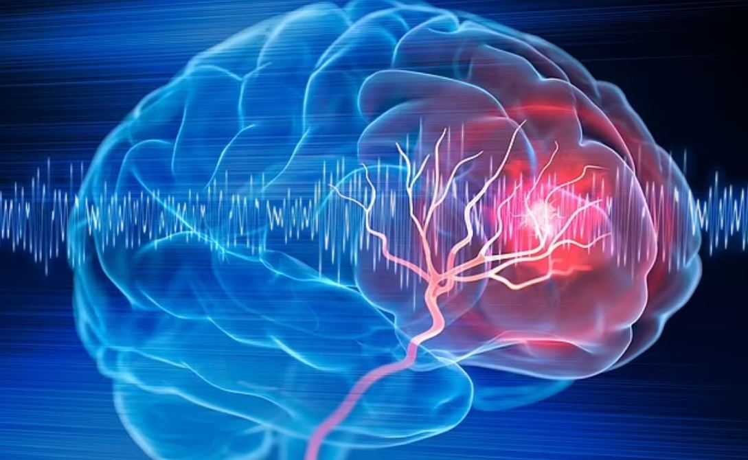 Bệnh nhân đột quỵ có nhiều khả năng hồi phục hoàn toàn hơn tới 48% khi được chẩn đoán bằng công nghệ AI