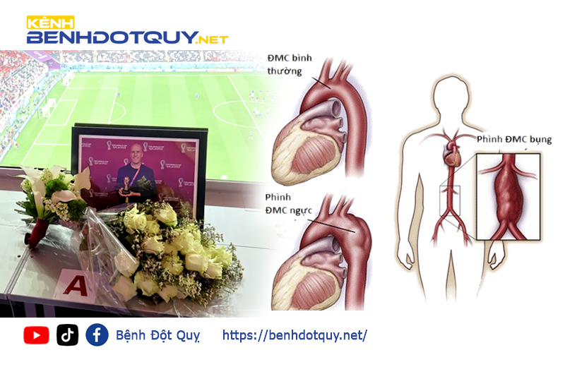 Mức độ nguy hiểm của bệnh phình động mạch chủ khiến phóng viên Mỹ đột tử tại World Cup