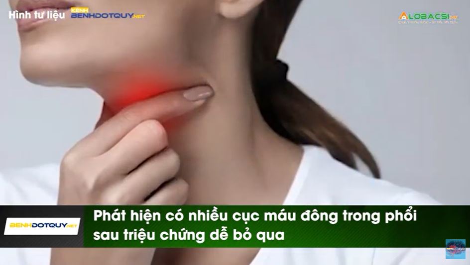 Phát hiện có nhiều cục máu đông trong phổi sau viêm họng