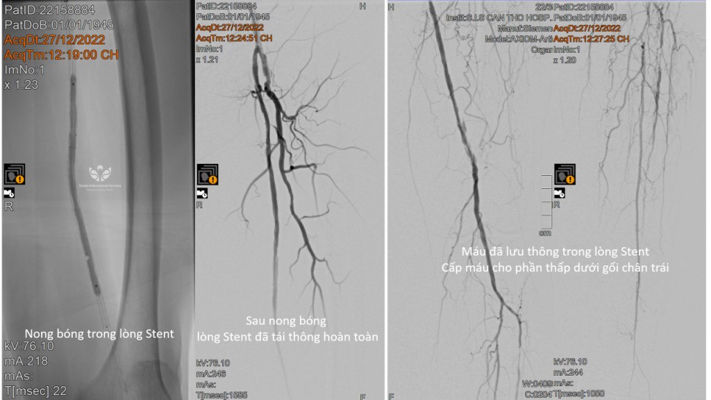 Sau khi nong bóng, lòng stent đã tái thông hoàn toàn, máu lưu thông đến phần thấp dưới gối chân trái
