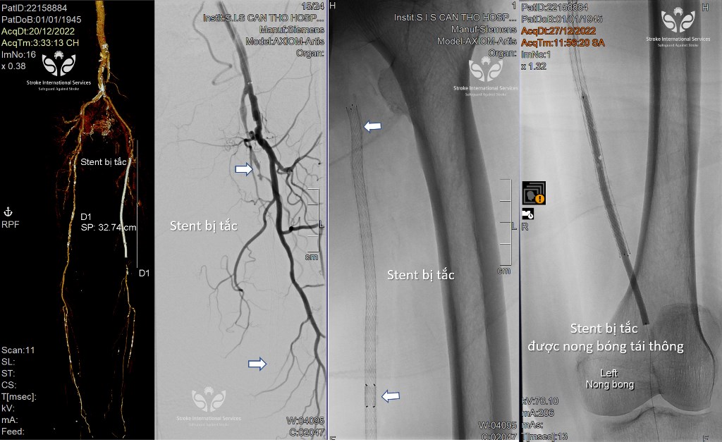 Đoạn stent 25cm bị tắc và được bác sĩ S.I.S nong bóng tái thông