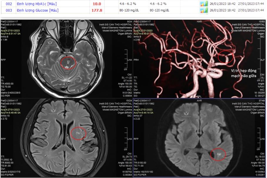 Nỗi lo của bác sĩ: Đột quỵ trẻ đã không còn hiếm