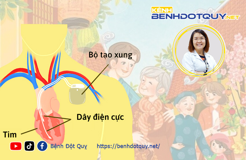 Làm sao giữ an toàn cho người đặt máy tạo nhịp tim đi chơi tết?
