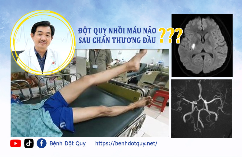 Tình huống khó: Bệnh nhân nhồi máu não sau chấn thương đầu, bác sĩ phải làm gì?