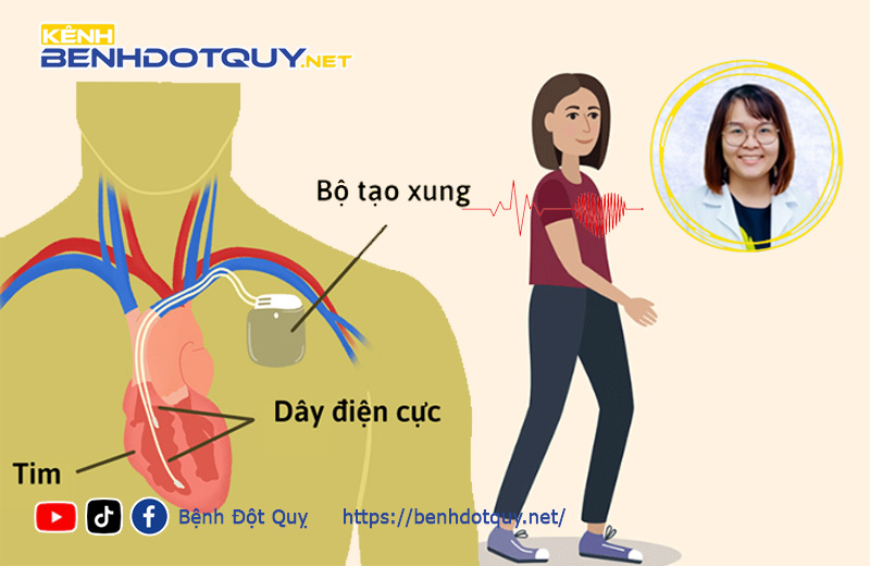 Người đặt máy tạo nhịp tim vận động, thể dục sao cho an toàn?